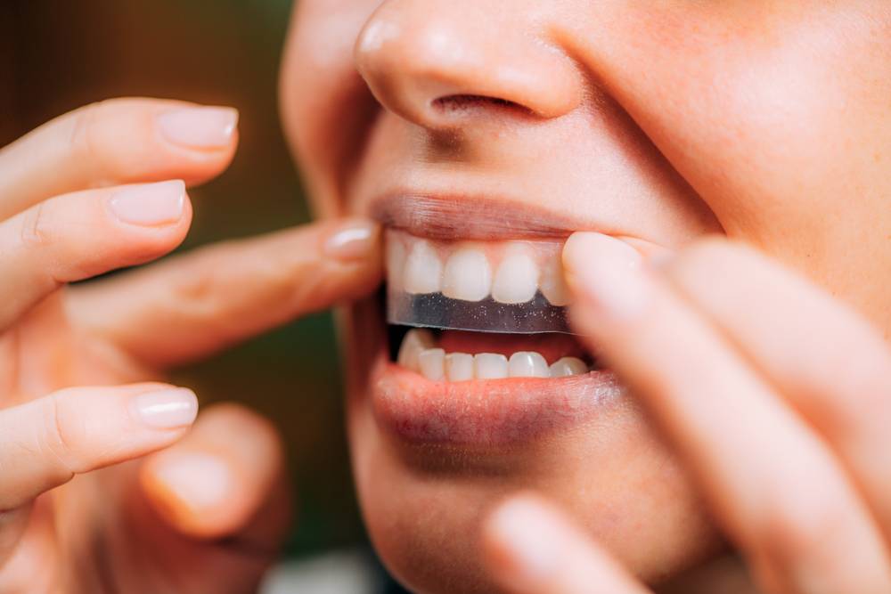 blanchiment dentaire comment ça fonctionne? Trois techniques décrites