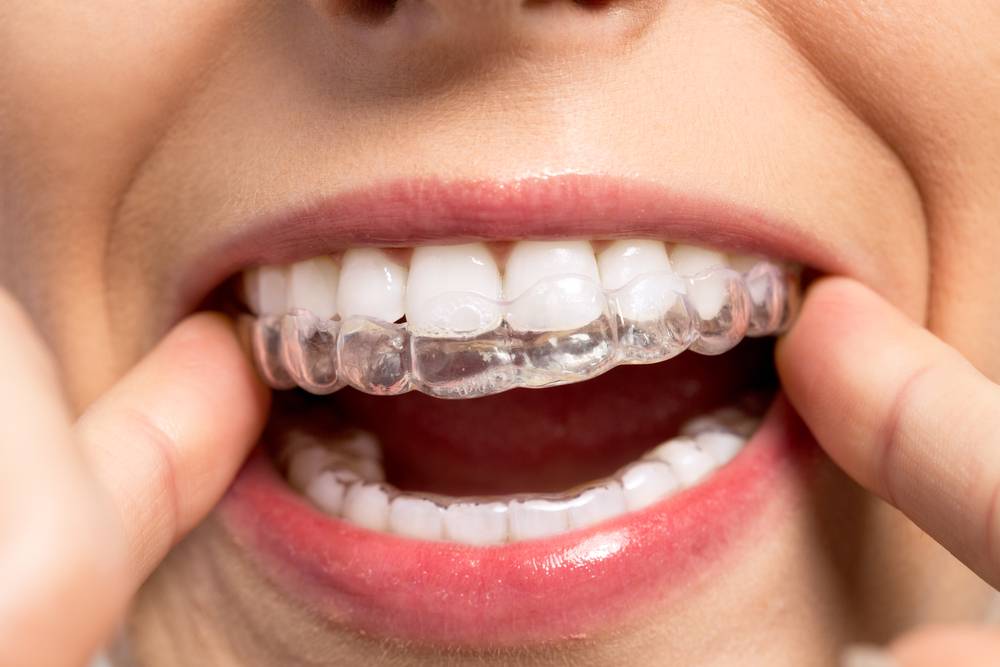 Le peroxyde d'hydrogène blanchit-il les dents en toute sécurité ?